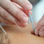 acupuntura